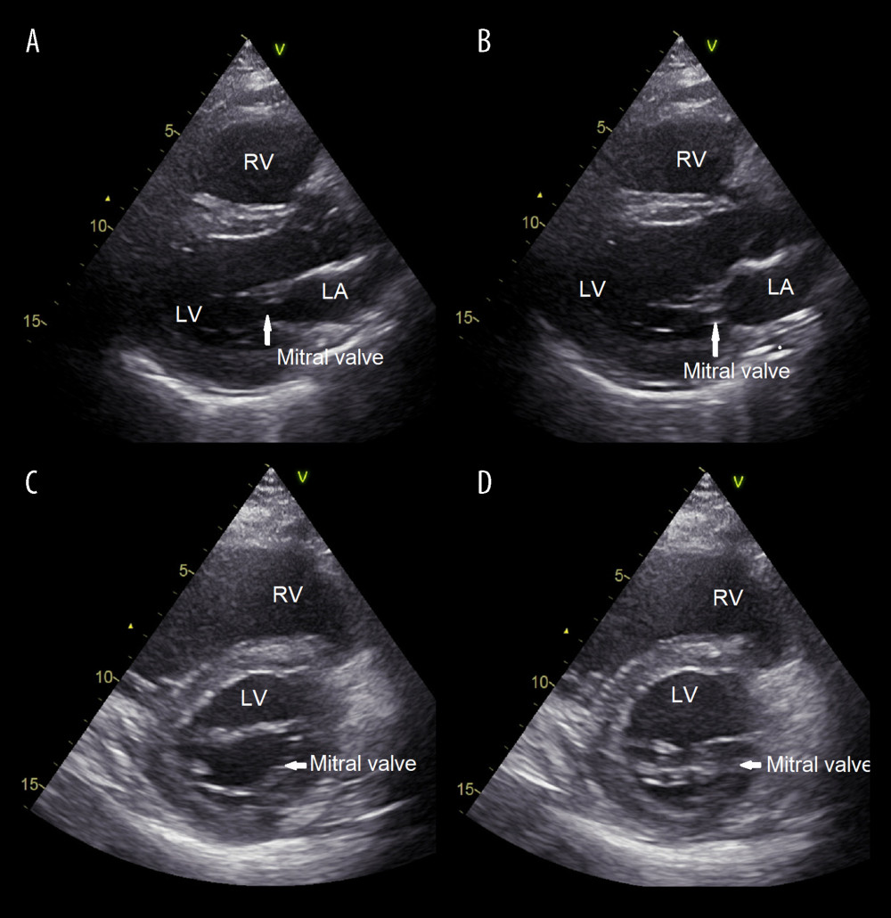 Transthoracic echocardiogram shows left ventricular dysfunction. Parasternal long-axis view in diastole (A); parasternal short-axis view in systole (B); parasternal short-axis view at the level of the mitral valve in systole (C); parasternal short-axis view at the level of the mitral valve in diastole (D). LV – left ventricle; RV – right ventricle; LA – left atrium.