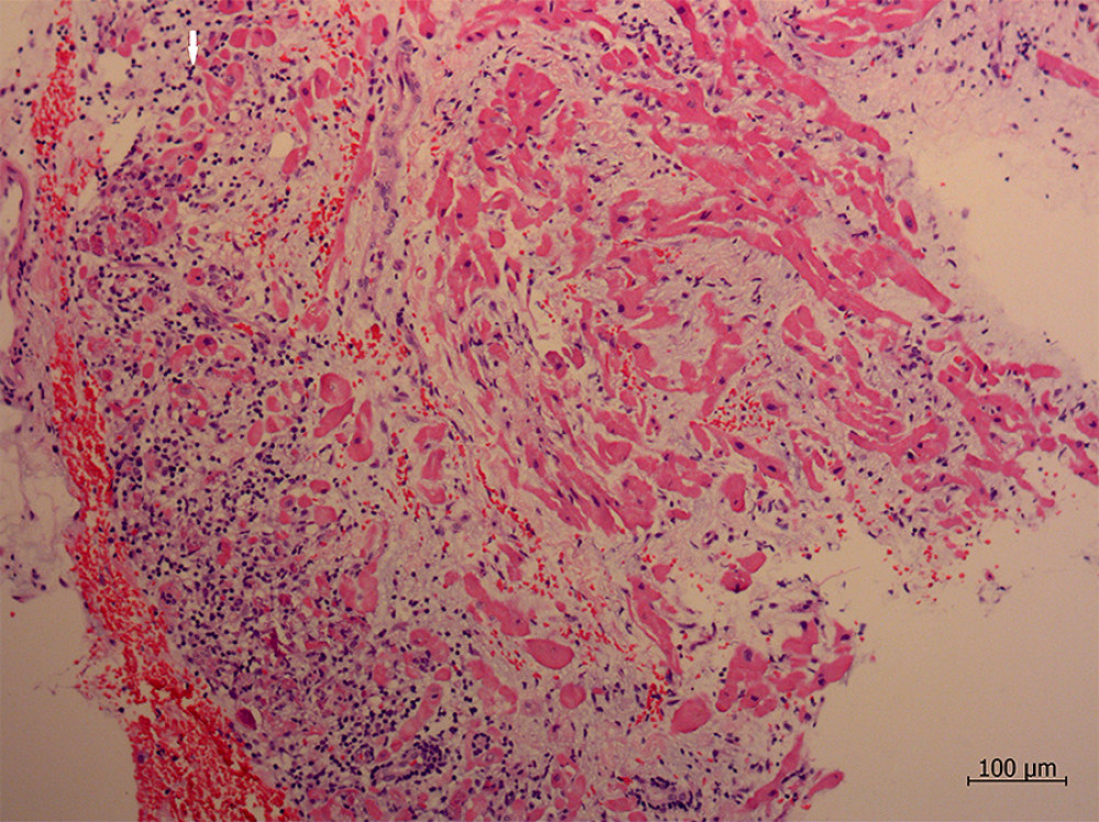 Endomyocardial histology shows an extensive inflammatory infiltrate along with myocyte dropout and necrosis. The interstitial inflammatory infiltrate consists predominantly of lymphocytes (white arrow).