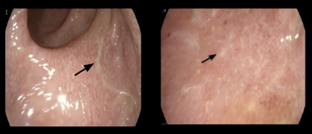 White exudate with inflamed mucosa detected by colonoscopy.