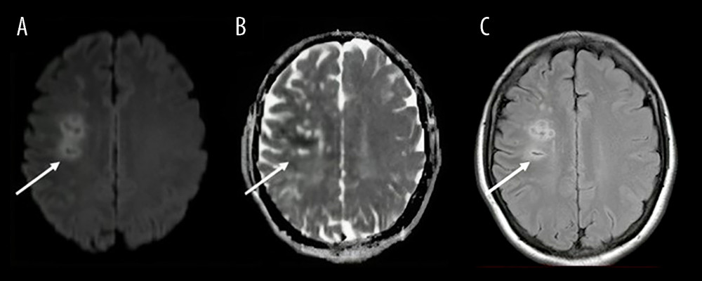 Case 1. Acute right middle cerebral artery infarction localized to the corona radiata (arrow) (A) Diffusion-weighted imaging. (B) Apparent diffusion coefficient. (C) Fluid-attenuated inversion recovery.