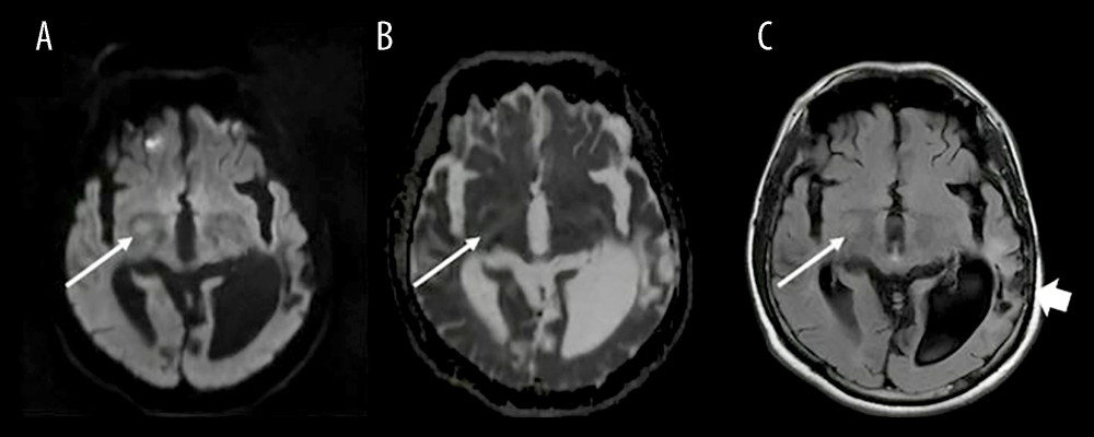 Case 2. Subacute right middle cerebral artery infarction showing internal capsule ischemic lesion. (A) Diffusion-weighted imaging. (B) Apparent diffusion coefficient. (C) Fluid-attenuated inversion recovery. Left parietal encephalomalacia and gliosis secondary to previous neurosurgery (wide arrow).