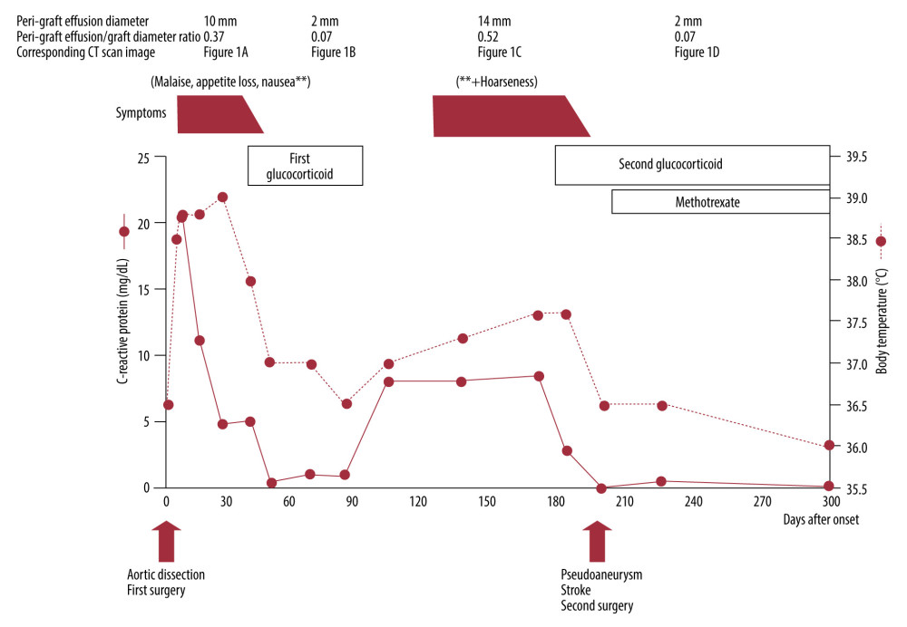 Timeline. Time course of symptoms, body temperature, serum C-reactive protein level, and peri-graft effusion volume and its association with glucocorticoid treatment and aortic surgery are shown.