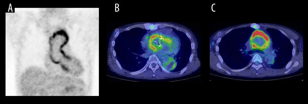 An 18-F fluorodeoxyglucose positron emission tomography (FDG-PET) scan image. (A) Coronal section of FDG-PET scan, revealing high uptake around the ascending aorta and arch grafts, indicating inflammation around the grafts (Gelweave Valsalva™ and Triplex™). (B) Transverse section of FDG-PET CT scan at the level of aortic root (prosthetic valve and Gelweave Valsalva™). High uptake was noted in the aortic root, but not in the descending aorta. (C) Transverse section of FDG-PET CT scan at the level of aortic arch (Triplex™). High uptake was noted around the arch graft (Triplex™).