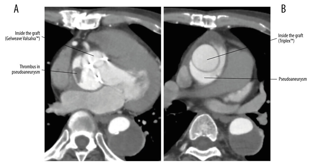 Contrast-enhanced computed tomography at the onset of stroke 6 months after the first surgery. (A) Aortic root just above implanted aortic valve (Gelweave Valsalva™). Contrast was leaked into pseudoaneurysm. Thrombus was noted in the pseudoaneurysm. (B) Ascending aortic graft: Triplex™. Contrast was leaked into the pseudoaneurysm.