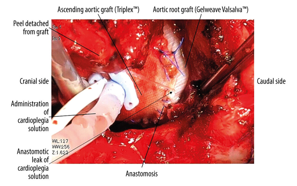 Photograph of anastomotic leak and peel dehiscence. Intraoperative photograph showed anastomotic leak of cardioplegia solution between Triplex™ and Gelweave Valsalva™. The finding of a relatively clean surface of the grafts suggested no adhesion process had occurred between the grafts and the surrounding tissue (peel) 6 months after the initial surgery.
