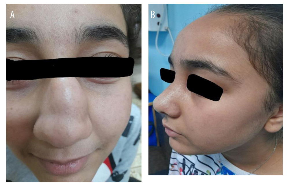 (A) Patient with unilateral nasal swelling. (B) Patient post-operatively.