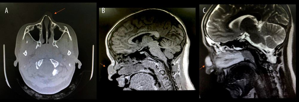 (A) CT scan shows well-defined hypodense lesion on the anterior aspect of the nasal cavity. (B) MRI T1 scan shows well-defined hypodense lesion on the anterior aspect of the nasal cavity. (C) MRI T2 scan shows welldefined hyperdense lesion on the anterior aspect of the nasal cavity.
