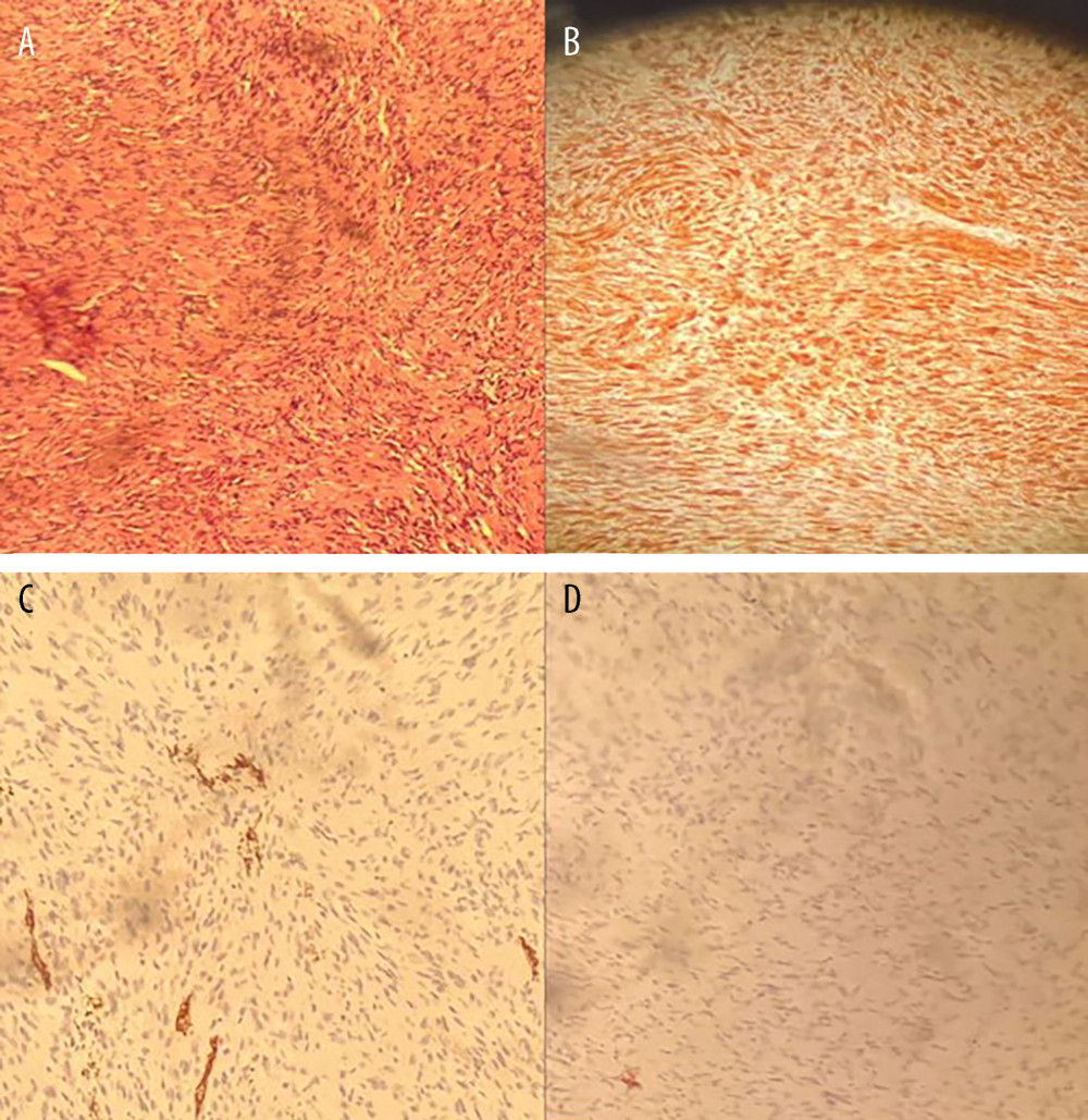 (A) Microscopic appearance showing a spindle cell tumor with both hypo and hypercellular areas. (B) S100 protein showing a diffuse staining as a characteristic feature for schwannoma. (C) Immunohistochemistry showing CD34 negativity in tumor cells with blood vessels marking. (D) Immunohistochemistry showing desmin negativity.