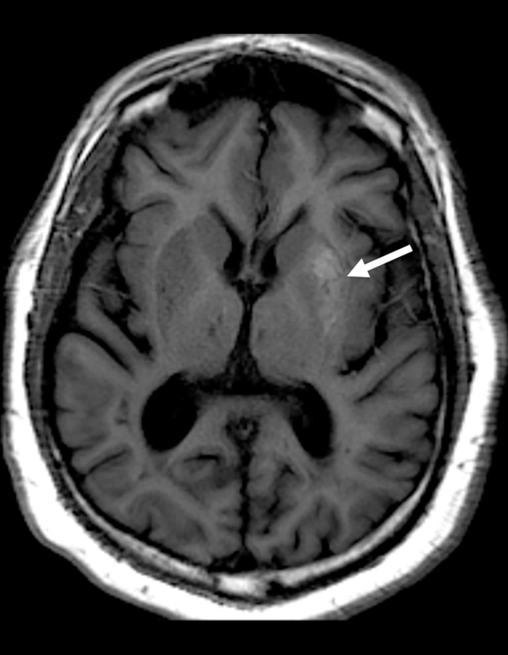 MRI head demonstrating diffuse T1 hyperintensity within the left lentiform nucleus (white arrow).