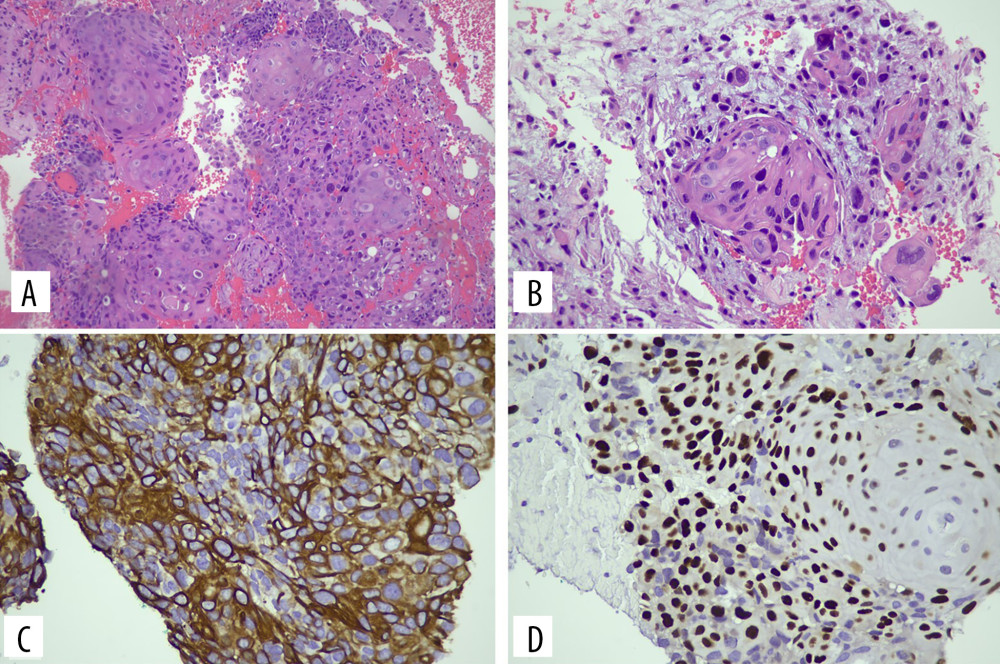(A, B) Histopathological slides from cyst wall curettage. The image shows multiple fragments of fibro-collagenous tissue infiltrated by malignant squamous cells arranged in trabeculae, nests, and singly distributed surrounded by desmoplastic stroma. The malignant cells are enlarged, polygonal, and moderately to markedly pleomorphic, displaying hyperchromatic nuclei, some with prominent nucleoli and ample eosinophilic cytoplasm. Mitosis is frequently seen. Dyskeratotic cells and focal intercellular bridges are present. No keratin pearl formation was noted. No lymphovascular invasion was seen. The background shows blood and some foamy macrophages. Hematoxylin & Eosin (H&E): 200× and 400× magnification. (C, D) The malignant cells are positive for squamous markers: (C) strong membrane/cytoplasmic staining for CK5/6, and (D) mild to moderate nuclear staining for the p63 tumor protein (400X magnification).
