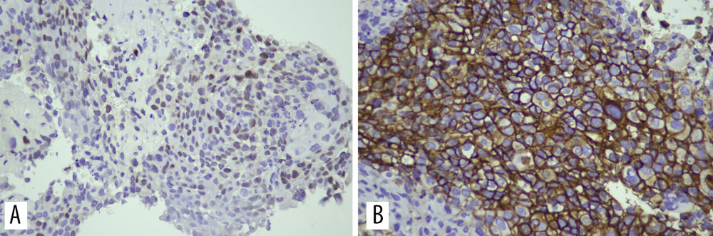 (A, B) Immunohistochemistry (IHC) of the cyst wall curettage. (A) IHC shows that malignant cells are positive for estrogen receptors with 40% positivity of moderate to strong intensity. (B) IHC shows strong expression (3+) for erythroblastic oncogene B-2 (c-erb-B2). (400× magnification) Progesterone receptor: negative.