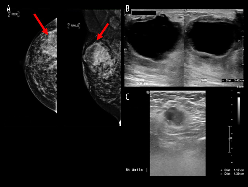 (A) Right breast mammogram. (B) Ultrasound of the right breast. (C) Ultrasound of the right axillary lymph node. (A) Right breast mammogram showing heterogenous fibro glandular density. The Breast imaging reporting and data system (BIRADS) level was C, showing a large mass at the right upper quadrant. Multiple smaller high-density lesions in the right upper quadrant of the breast are visible. An area of hyperdensity over the right breast, upper quadrant, is visible. The red arrows show a dense, microlobulated cystic mass (these are typical mammography findings prompting suspicion of breast cancer). There is an associated right breast diffuse opacity due to edema. No suspicious grouped microcalcifications were seen. (B) Large thick-walled lobulated cystic mass with septations occupying the right upper quadrant, measuring 2.7×3.4×3.4 cm. There was a linear hypoechogenicity across the anterior aspect of the lesion in keeping with the previous wound. Several ill-defined hypoechoic lesions at the medial aspect of the above-mentioned lesions were visible. They were increased in size and number compared with recent sonograms, at the 12 o’clock and 1 o’clock positions; ranging from 0.7 cm to 2.3 cm. The overlying skin appeared to be thickened. (C) Enlarged right axillary node with cystic area measuring 1.2 cm in short axis diameter.