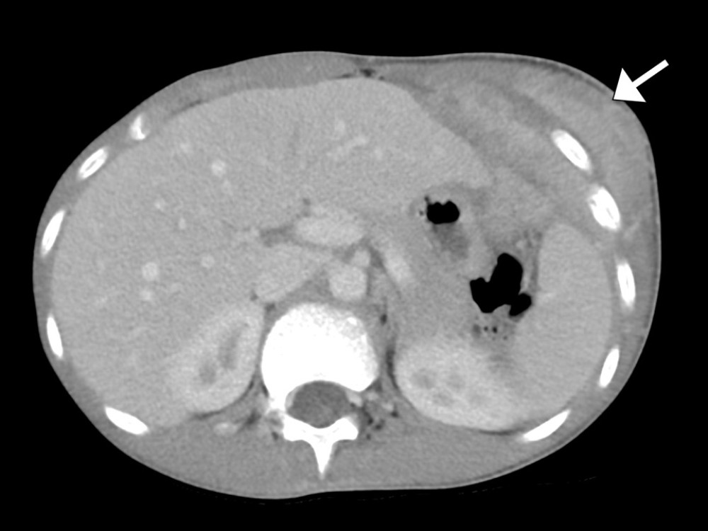 Axial computed tomography image of the chest showing a large tumor involving the lower chest wall with both soft tissue and bone components (arrow), raising suspicion for Ewing sarcoma.