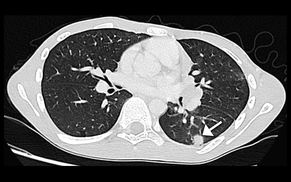 Axial computed tomography image of the chest displaying an ill-defined solid pulmonary nodule (arrow), suggestive of possible lung metastasis.