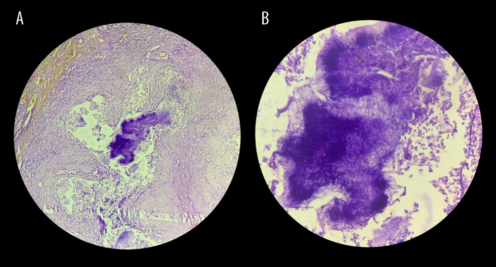 Histopathological image (A, Gram stain, low-power view at 100× magnification) illustrating granulomatous inflammation displaying the Splendore-Hoeppli phenomenon, with blue-staining bacteria encircled by intensely eosinophilic deposits. These formations represent characteristic asteroid bodies within the tissue. (B, High-power view at 400× magnification) provides a closer view of this unique histological feature.