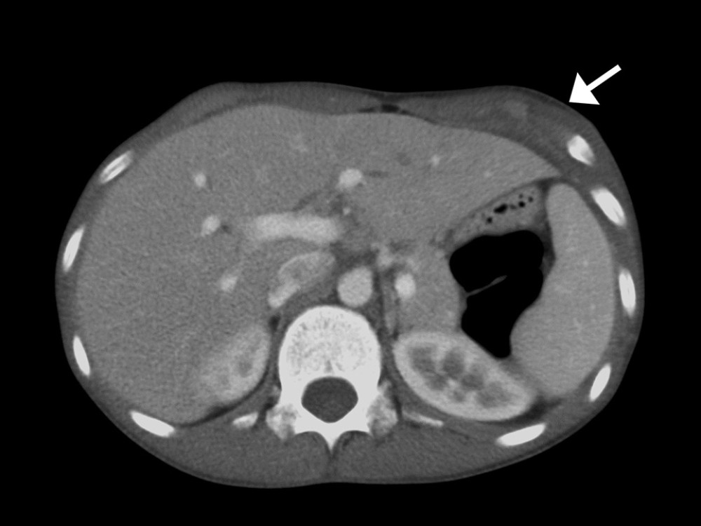 Follow-up computed tomography image of the chest revealing a marked reduction in the size of the previously observed lateral chest wall lesion (arrow) after treatment.