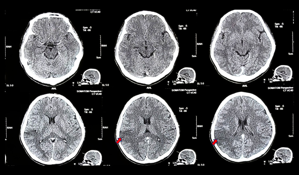 First non-contrast head CT scan. The patient’s first non-contrast head CT scan on the second day following his neurological deficits showed mild cerebral edema without any intracerebral infarction or hemorrhage, ASPECT score 10. Red arrows indicate cerebral edema.