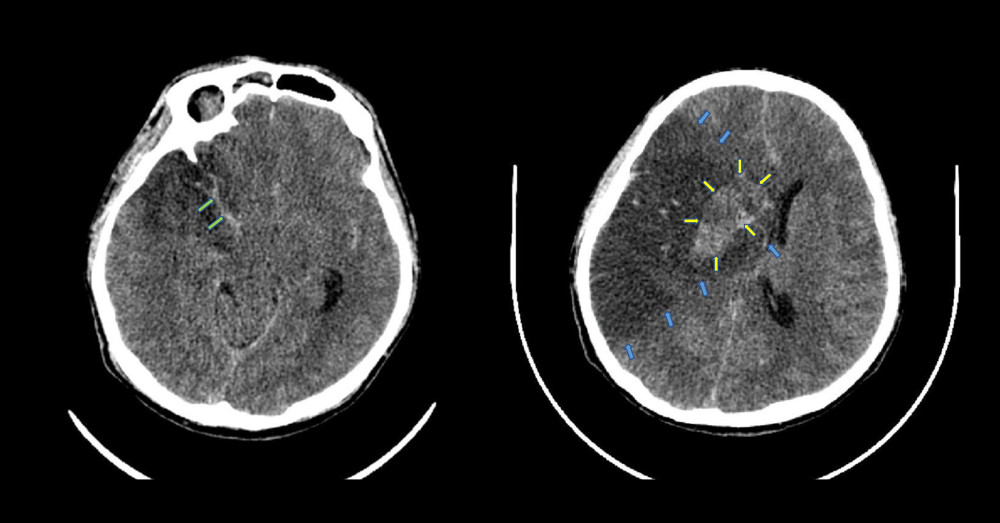 Second non-contrast head CT scan. The patient’s second non-contrast head CT scan on the 4th day after his firs neurological deficits showing subarachnoid hemorrhage in right parietal region (green arrows), intracerebral hemorrhage in right basal ganglia (yellow arrows) that causes midline shift to the left, and cerebral infarction in right frontotemporoparietal regions (blue arrows) with ASPECT score 1.