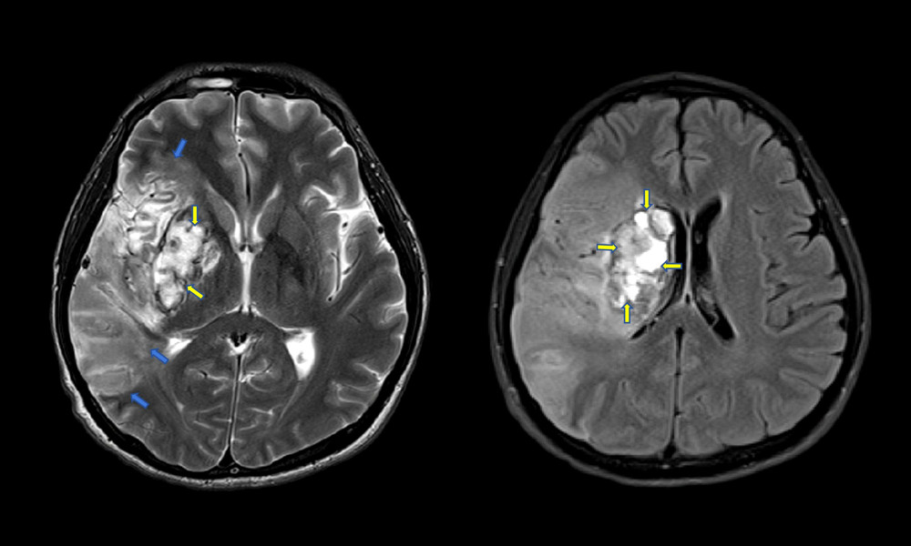 Brain MRA axial T2 showing cerebral infarction in right frontotemporoparietal regions (blue arrows) with hemorrhagic transformation in right basal ganglia (yellow arrows) without any midline shift.
