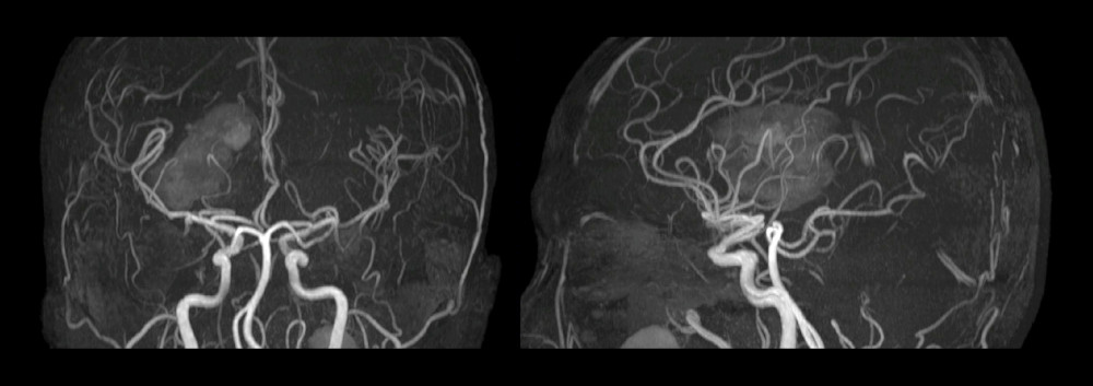 Brain MRA showing normal bilateral medial, anterior, and posterior cerebral arteries, vertebral arteries, anterior and posterior communicating arteries, internal carotid arteries, as well as basilar arteries, without aneurysms.