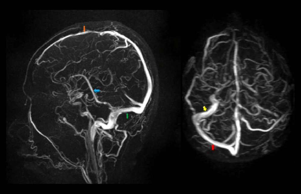 Brain MRV showing non-visualization of left transverse and sigmoid sinuses with normal visualization of superior (orange arrow) and inferior sagittal sinuses (blue arrow), straight sinus (green arrow), and right transverse (red arrow) and sigmoid sinuses (yellow arrow).