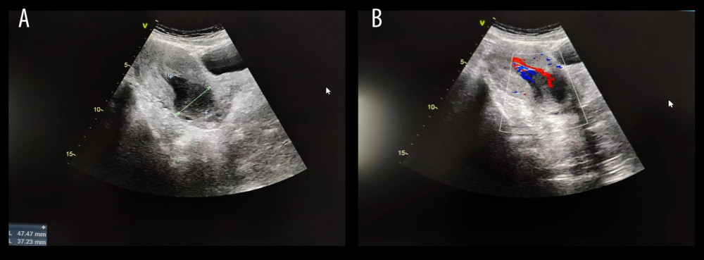 Transvaginal ultrasound image of the lesion. (A) A solid echo with a size of 5.1×3.6×3.4 cm in the lower uterine cavity. (B) A solid echo with rich blood flow signals.