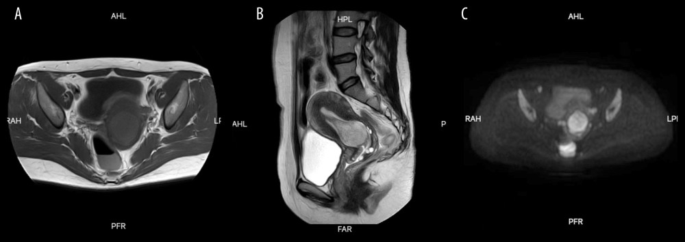 MRI image of the lesion. (A) A mass of slightly short T1 signal at the bottom of uterine cavity, the mass size was about 6.0×3.4×4.0 cm. (B) A mass of long T2 signal at the bottom of uterine cavity. (C) A mass with slightly DWIBS signal densification.