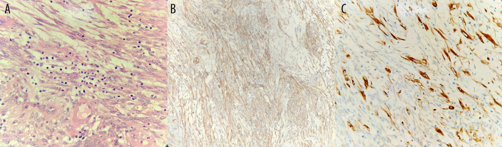 Uterine inflammatory myofibroblastic tumor. (A) Most tumor cells were arranged in fascicles with scattered lymphocyte infiltration. (B) Immunohistochemical staining for SMA was positive. (C) Tumor cells in the myxoid areas were strongly positive for ALK. (Hematoxylin-eosin, [A]; original magnification 200× [A-C]). SMA – smooth-muscle actin; ALK – anaplastic lymphoma kinase.