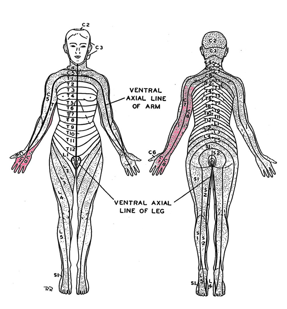 The patient’s neurologic fallout using dermatomes. Hyposensitivity in the right C7 and C8 regions (pink zone).