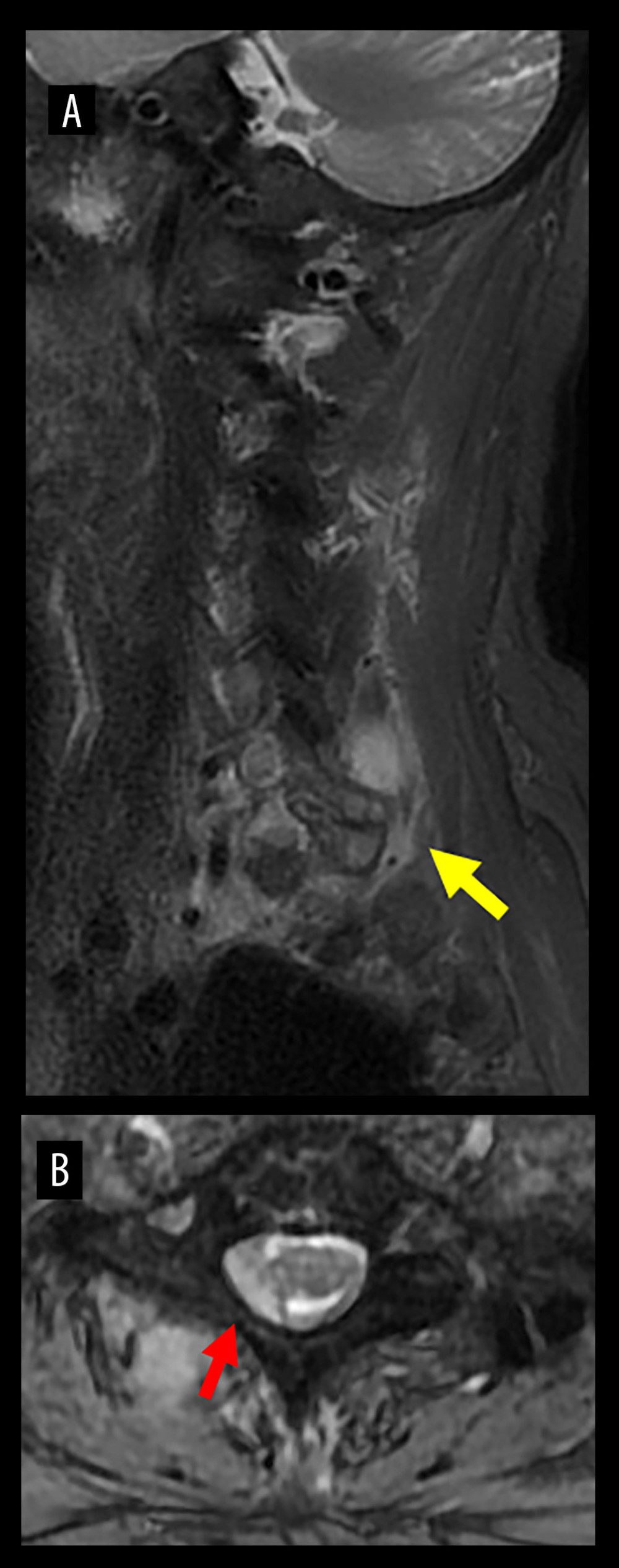 MRI of the cervical spine at admission. Sagittal (A) and axial (B) STIR images. High signal change in the right facet joint and paraspinal muscle of C7/Th1 (yellow arrow) and epidural mass lesions extending from the C6/7 and C7/Th1 intervertebral foramen to the spinal canal (red arrow) were confirmed.