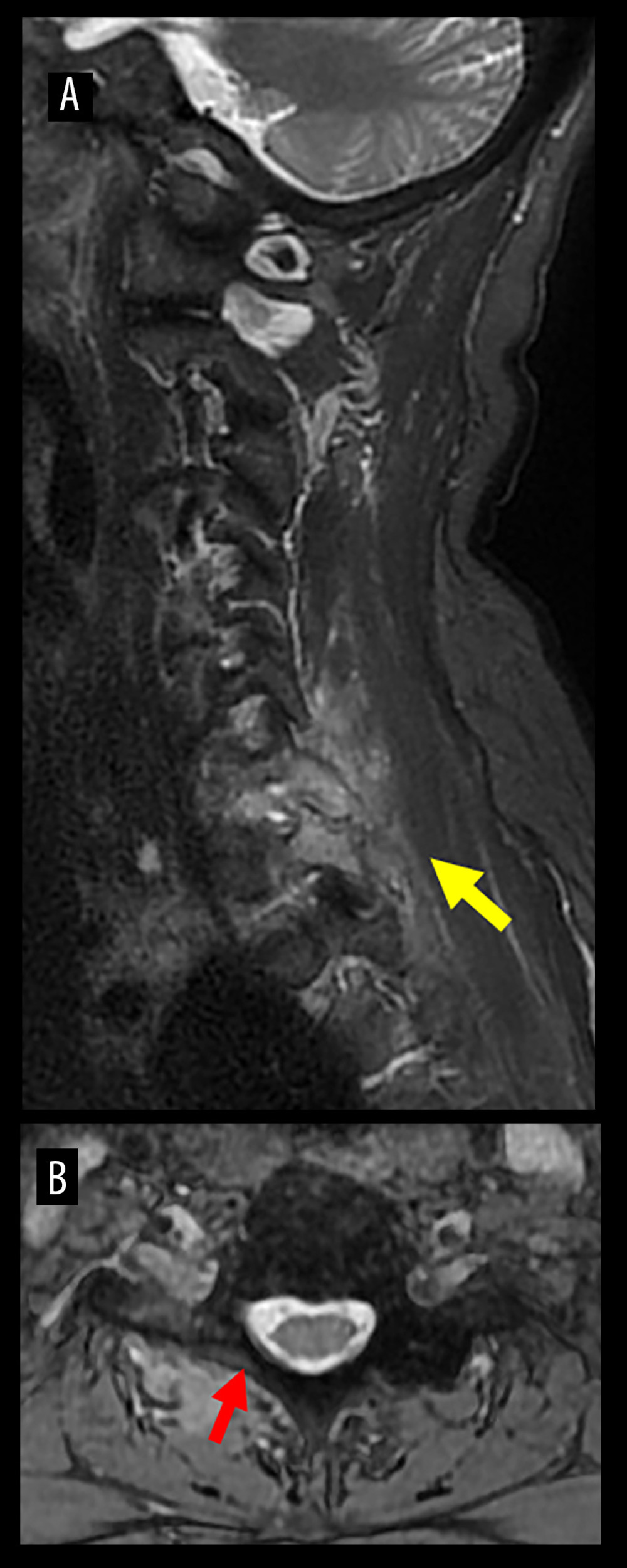 MRI of the cervical spine on day 30. Sagittal (A) and axial (B) STIR images. Continuation of high signal change in the right facet joint of C7/Th1 (yellow arrow) and disappearance of the epidural abscess (red arrow) were confirmed.