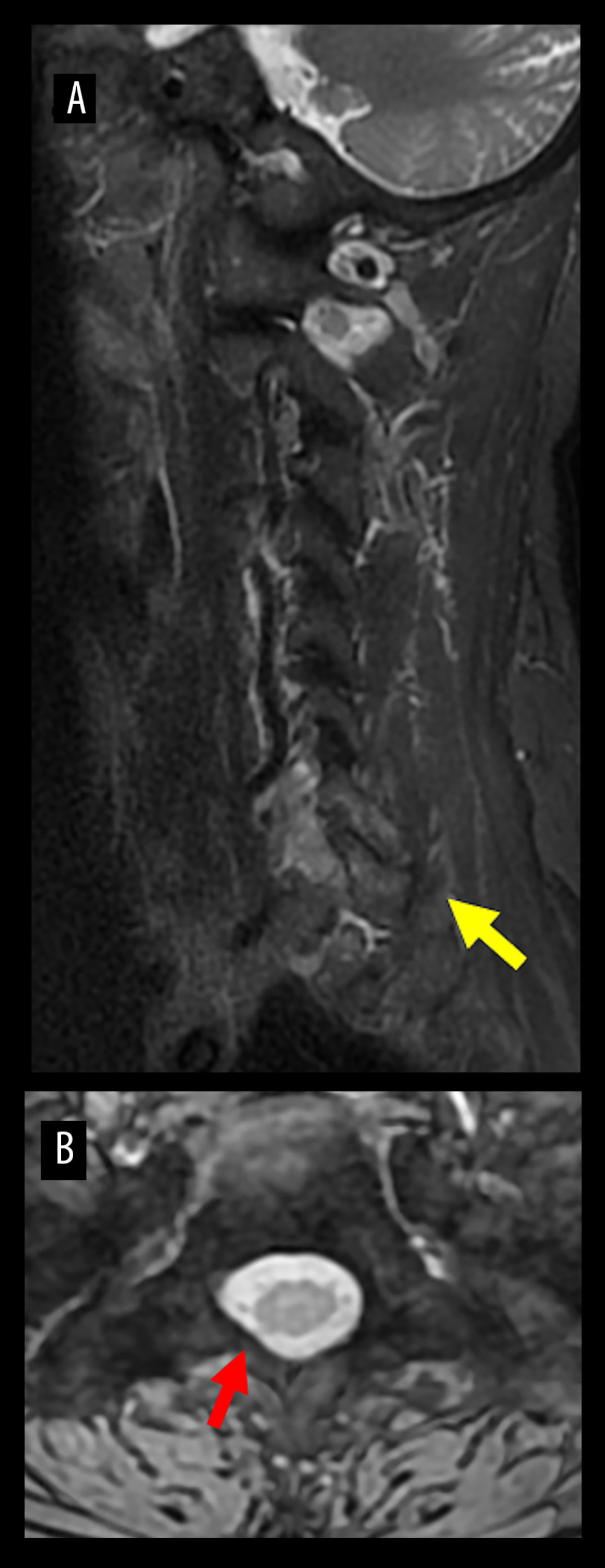 MRI of the cervical spine on day 93. Sagittal (A) and axial (B) STIR images. Continuation of high signal change in the right facet joint of C7/Th1 (yellow arrow) and disappearance of the epidural abscess (red arrow) were confirmed.