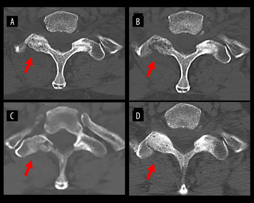 Changes in CT of the cervical facet joint. Axial image at the same level over time. (A) Day 1, (B) day 10, (C) day 41, (D) day 191. On day 1, only deformation in the cervical spine was noted, but bone destruction on the right facet joint of C7/Th1 was confirmed on day 10. Day 41 showed no progression of facet joint destruction compared to day 10. Fusion of the right facet joint of C7/Th1 was confirmed on day 191.