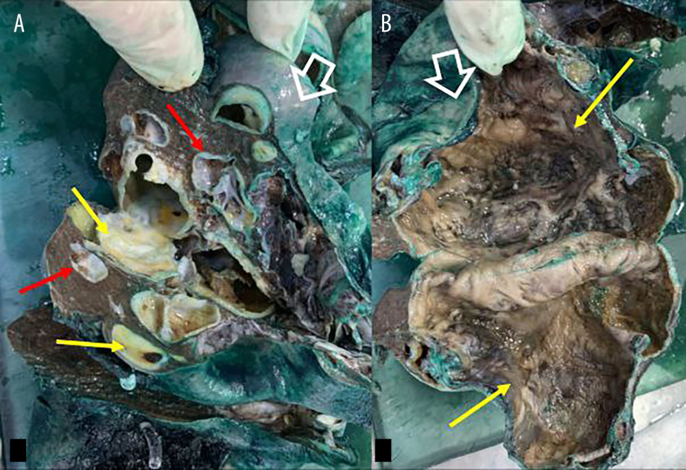 (A) The outer capsule of the spleen shown here is inked green (empty white arrow) and the cut sections reveal multiple cysts of variable sizes present within the splenic parenchyma, with glistening, white, shiny lining (red arrows) and calcified hard areas (yellow areas). Superior view. (B) The capsule of the spleen is shown again (empty white arrow) and the largest cyst within the spleen is opened, revealing a denuded, coarse, fibrotic surface (yellow arrows). Superior view.