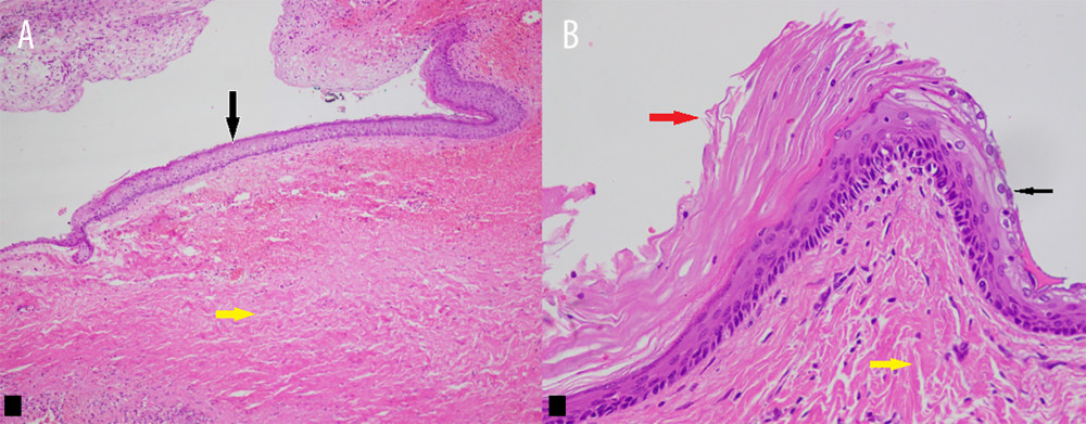 (A) The lining of some of the cysts is composed of keratinizing squamous epithelium resembling the epidermis of the skin with the red arrow pointing to the keratin layer, the black arrow pointing to the multilayered squamous epithelium and the yellow arrow pointing at the collagen bundles of the underlying fibrous tissue. Original magnification, 400× (Hematoxylin and eosin stain). (B) Lower magnification of the cyst wall shows the stratified squamous lining (black arrow) and the underlying fibrous connective tissue (yellow arrow). Original magnification, 100× (hematoxylin and eosin stain).