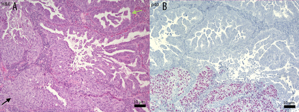 (A) Histological assessment of the cervical lesion showed an epithelial tumor consisting of both atypical glands (green arrow) and a solid growth pattern (black arrow). (B) Only the squamous tumor component showed immunohistochemical p40 reactivity.