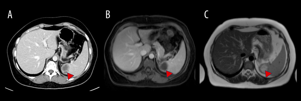 (A) The portalvenous phase computed tomography scan showed a splenic lesion with a central hypodense area and a thick enhancing rim, while the adjacent adipose tissue is unremarkable. (B) The venous phase T1 fs magnetic resonance imaging (MRI) displayed a solid, strong enhancing rim of the splenic lesion with no hyperperfusion of the adjacent splenic tissue. (C) Correspondingly, the T2w MRI (HASTE) showed a high signal center, indicating the necrotic area. The splenic lesion is marked by a blue arrow bar.