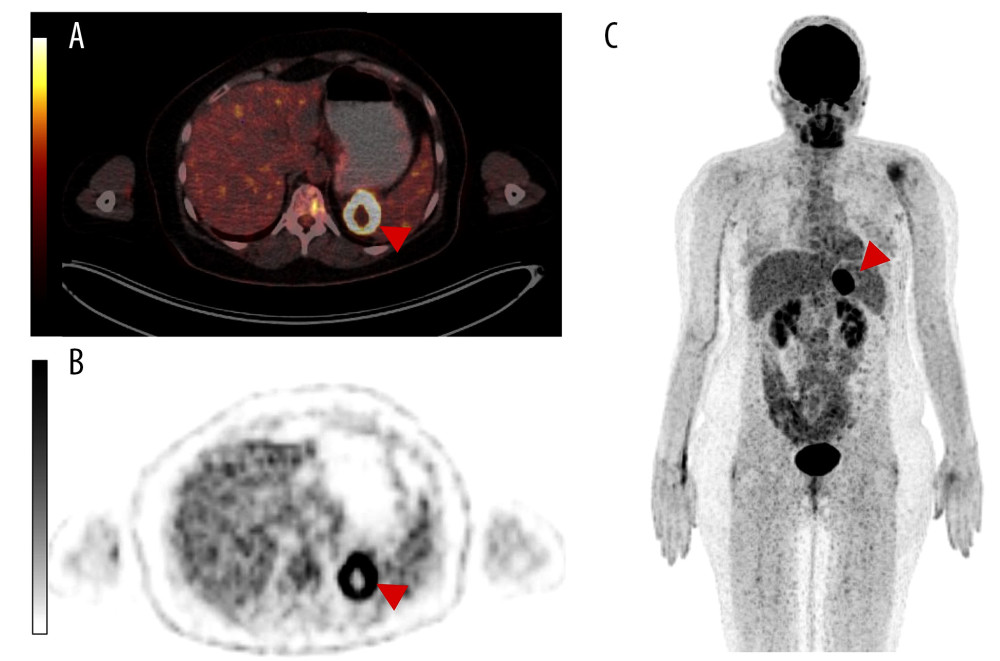 An intense circular uptake at the mediodorsal splenic pole (red arrowheads) can be seen in positron emission tomography/ computed tomography (PET/CT) scan with [18F] FDG (179 MBq). (A) Exemplary transversal image of PET/CT fusion and (B) PET; (C) maximum intensity projection.