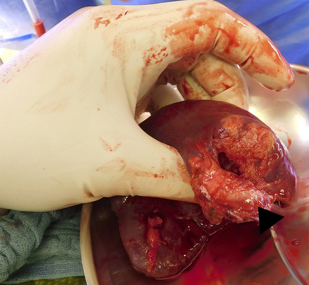 Intraoperative view of the mediodorsal area of the spleen. The gross pathological finding of a solid, irregularly shaped lesion with an inhomogeneous whitish-brownish appearance and a centrally softened consistency on the cut surfaces is highly suspicious for splenic metastasis (arrow-mark).