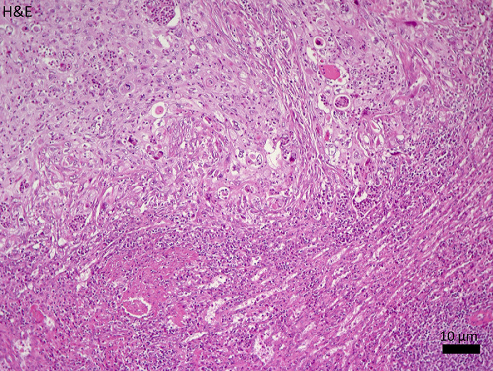 The histopathological examination after splenectomy revealed an epithelial lesion with pleomorphic nuclei and a high rate of mitosis diffusely infiltrating the local splenic parenchyma.