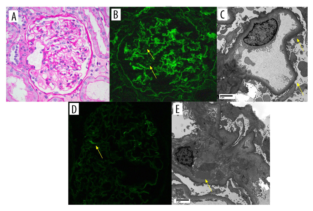 Kidney biopsy findings. (A) Light micrograph demonstrating unremarkable glomerulus (periodic acid Schiff stain; 400×). (B) Immunofluorescence stain for anti-human IgG demonstrating fine granular podocyte cytoplasmic “dusting” with IgG (arrows) (400×; contrast enhanced from original image for enhanced visualization of weak deposits). (C) Electron micrograph demonstrating a representative glomerular capillary loop with extensive podocyte foot process effacement (arrows). (D) Immunofluorescence stain for anti-human IgA demonstrating segmental weak granular mesangial IgA deposition (400×). (E) Electron micrograph of a mesangial region demonstrating a rare mesangial electron-dense deposit (arrow).