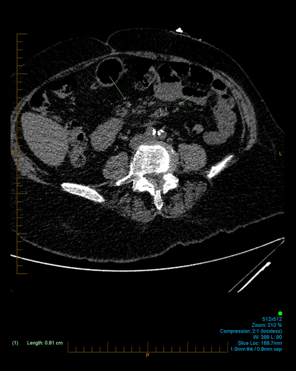Transverse computed tomography slice showing central mesenteric fat stranding with scattered lymph nodes interspersed in between, measuring up to 8 mm in the short axis, reflective of mesenteric panniculitis, marked by the green arrows.