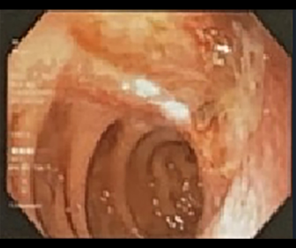 Upper gastrointestinal endoscopy findings showed a large ulcer on the posterior wall of the second part of the duodenum, covered with pseudomembranous.