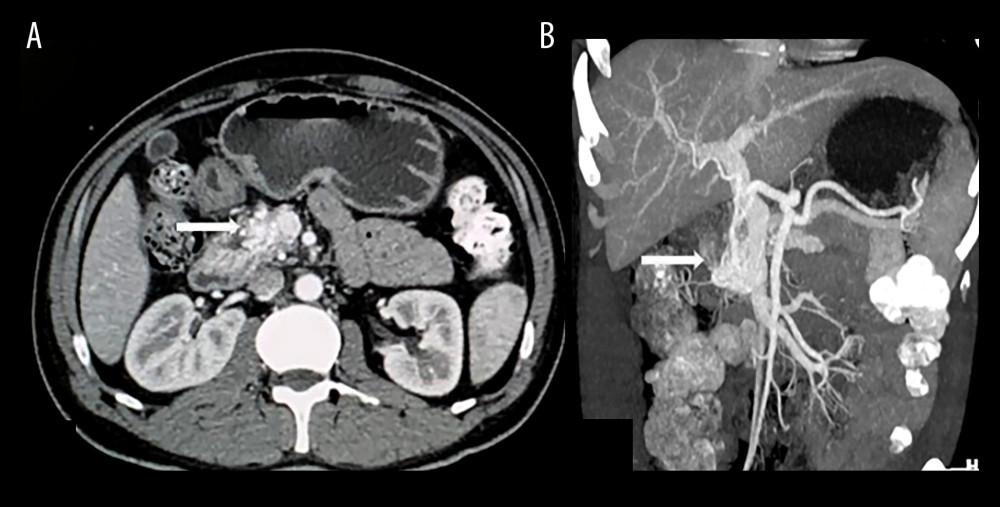 A contrast-enhanced computed tomography scan of the abdomen revealed the enhancement of vascular structures in the pancreatic head (white arrows), with (A) coronal and (B) sagittal view.