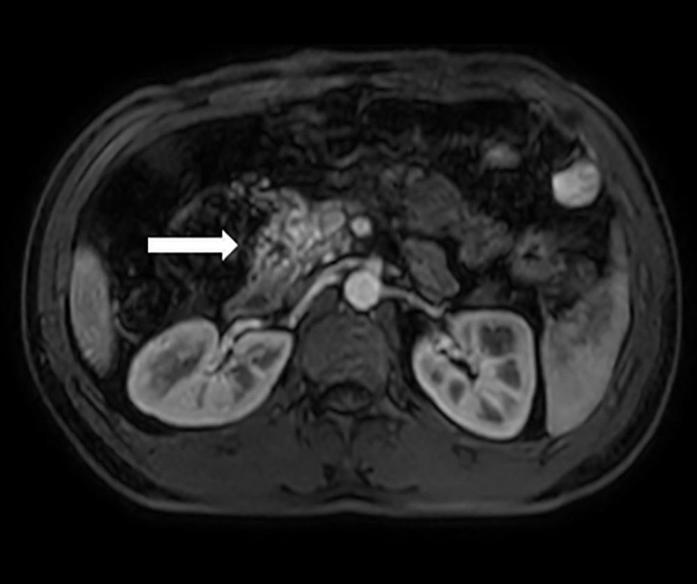 Abdominal magnetic resonance imaging reveals heterogeneous parenchyma of the head and isthmus of the pancreas, increasing signal on T2-weighted imaging, and coil-like shape after administering contrast (white arrow).
