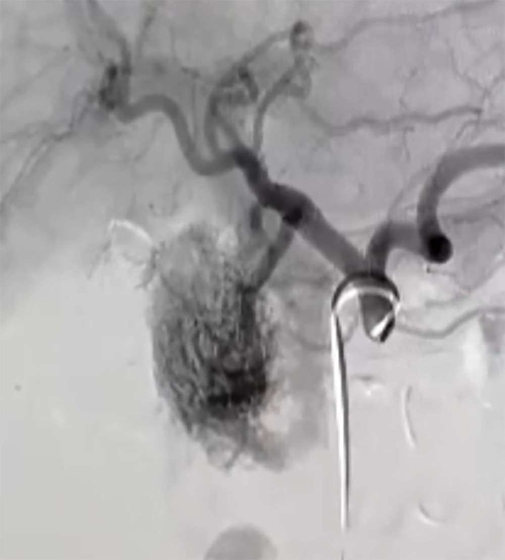Angiography shows a racemose vascular network in the head of pancreas.
