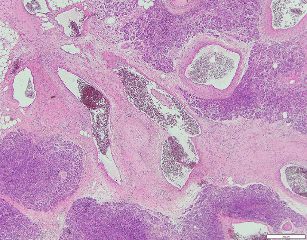 Histopathological results on the hematoxylin and eosin staining demonstrate dilated and tortuous veins and arteries.