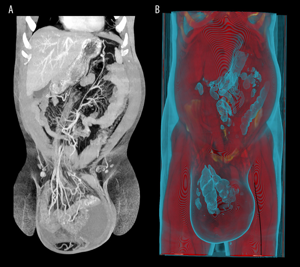 (A) Computed tomography with frontal view of the incarcerated giant right-sided hernia of small bowel and right colon with free fluid in declive part of the scrotum. (B) Three-dimensional computed tomography reconstruction of the incarcerated right-sided hernia with right colon and small bowel.