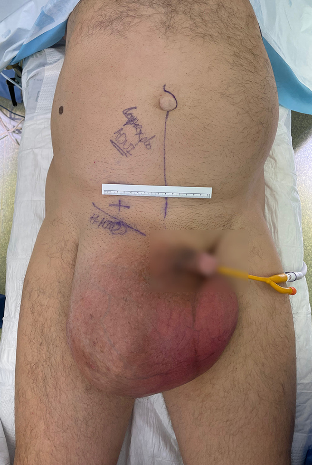 Overview of the giant right-sided hernia. Patient in supine position.