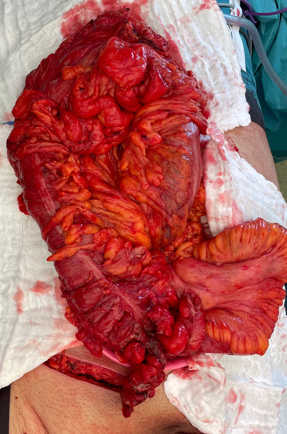 Intraoperative findings: last ileal loop, cecum with perforated appendix, ascending colon, transverse colon, and omentum were found as the contents of the hernia sac.